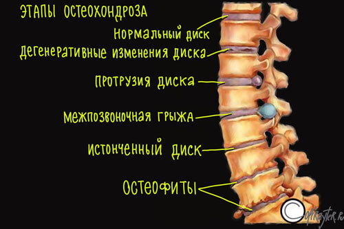 Авторский рисунок остеохондроз На картинке поэтапное разрушение позвоночника