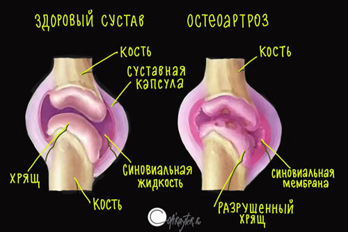 Авторский рисунок остеохондроз Наглядное описание хряща