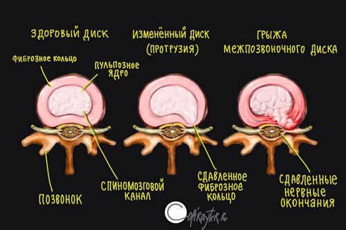 Матрас при остеохондрозе позвоночника